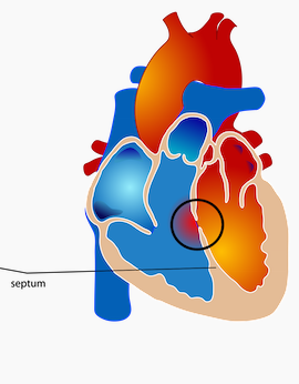 ventricular septal defect